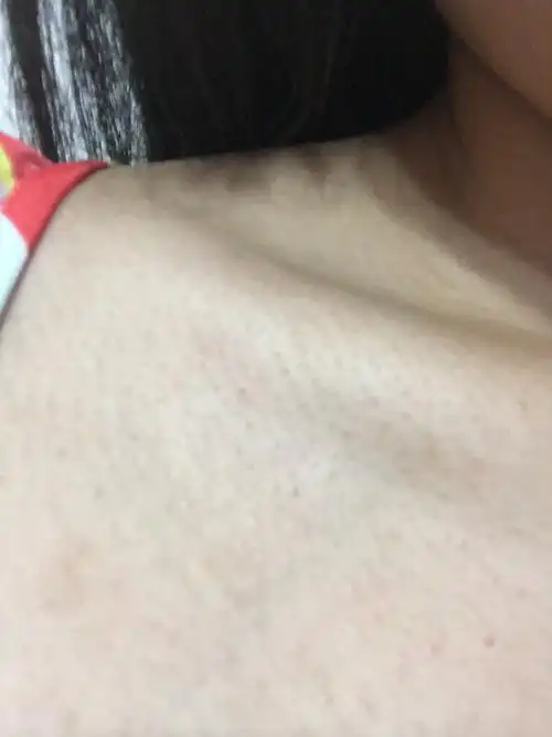 脖子以下胸以上皮肤毛孔粗大 是不是鸡皮肤啊 这样子穿衣服都不好穿很